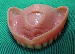 Dentadura com câmara de sucção