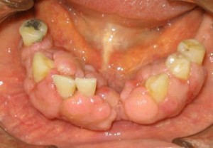 Hiperplasia medicamentosa