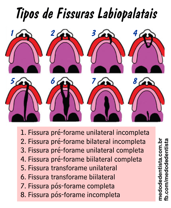 Tipos de fissuras labiopalatais