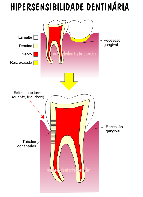 Qual é o dente que está inclinado a fazer alguma coisa? - Charada