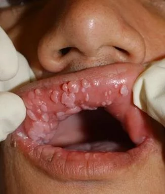 hpv tongue skin)