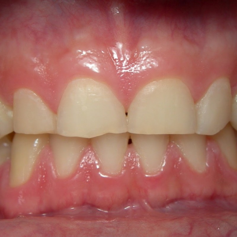 Dentes com desgaste por causa do bruxismo