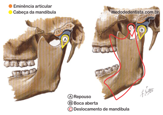 Deslocamento de mandíbula