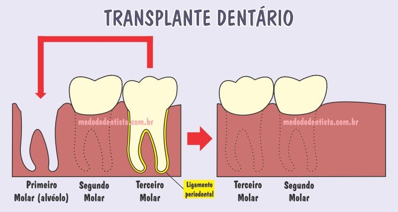 Transplante dentário