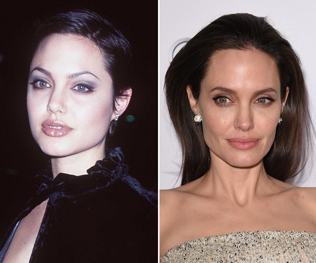 Angelina Jolie antes e depois da bichectomia