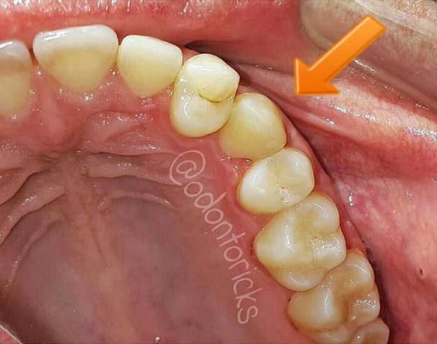 Transposição dentária